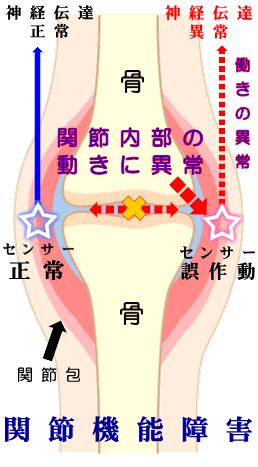 カイロプラクティック#サブラクセーション#関節関節 - 健康/医学